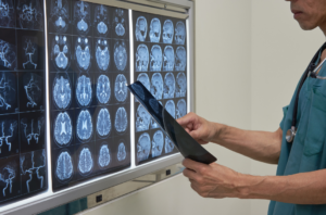 ¿Cuándo debes acudir a un neurocirujano? Señales que no debes ignorar